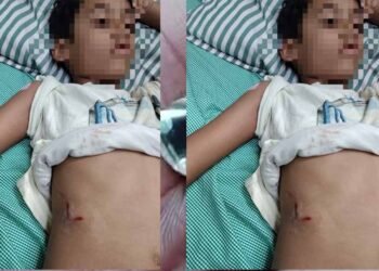 पेबल बे फेस 1, बागमुगलिया कटारा हिल्स में आवारा कुत्ते ने बच्चे को काटा