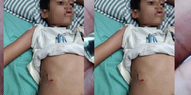 पेबल बे फेस 1, बागमुगलिया कटारा हिल्स में आवारा कुत्ते ने बच्चे को काटा