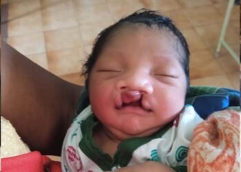 जब चिरायु टीम बनी एक परिवार की उम्मीद, जन्मजात विकृति से जूझ रहे बच्चे को मिला नया जीवन