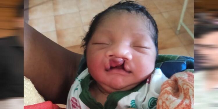 जब चिरायु टीम बनी एक परिवार की उम्मीद, जन्मजात विकृति से जूझ रहे बच्चे को मिला नया जीवन