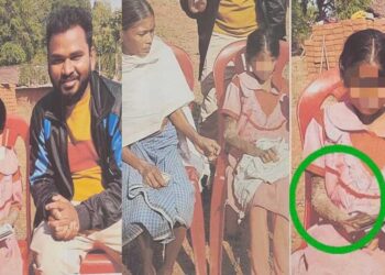 पत्थर शरीर वाली बच्ची के उपचार को लेकर बाल आयोग सक्रिय