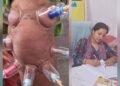लोहरसी आयुर्वेदिक औषधालय में दर्द प्रबंधन हेतु कपिंग थेरेपी एवं विशेष आयुर्वेदिक उपचार सेवाओं का आरंभ
