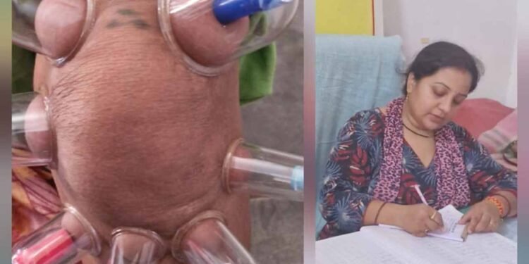 लोहरसी आयुर्वेदिक औषधालय में दर्द प्रबंधन हेतु कपिंग थेरेपी एवं विशेष आयुर्वेदिक उपचार सेवाओं का आरंभ