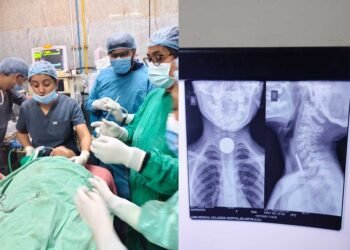 6 वर्षीय मासूम की आहार नली से सफलतापूर्वक निकाला गया सिक्का, बची जान