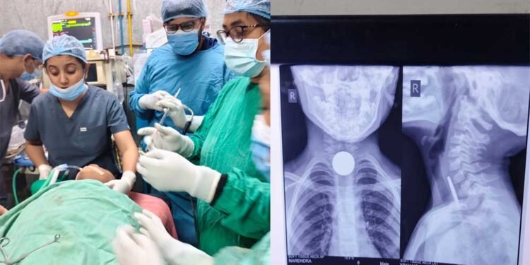 6 वर्षीय मासूम की आहार नली से सफलतापूर्वक निकाला गया सिक्का, बची जान