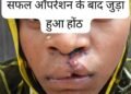 सफल सर्जरी से भीमे हेमला के चेहरे पर लौटी मुस्कान