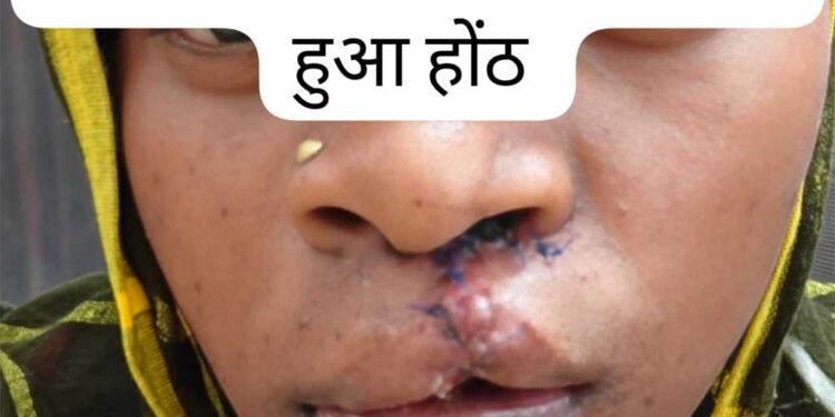 सफल सर्जरी से भीमे हेमला के चेहरे पर लौटी मुस्कान